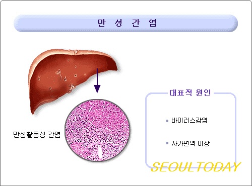 간 치료와 식이요법