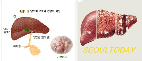 국내 연구진 간암 치료제 개발 길 열렸다